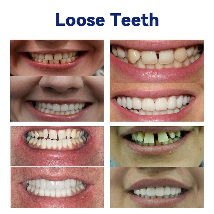 DentureSet Pro | Juego Completo de Dentaduras