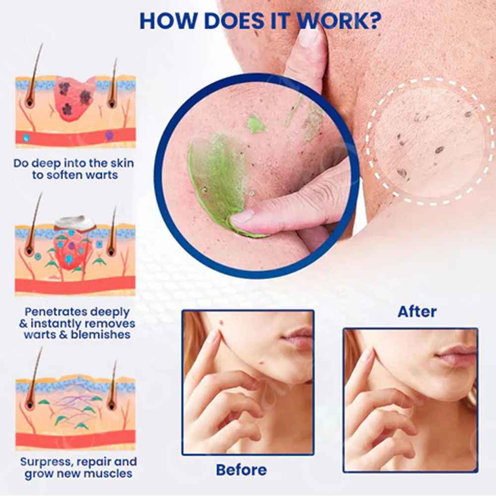 NatureErase | Gel para Manchas, Lunares y Verrugas