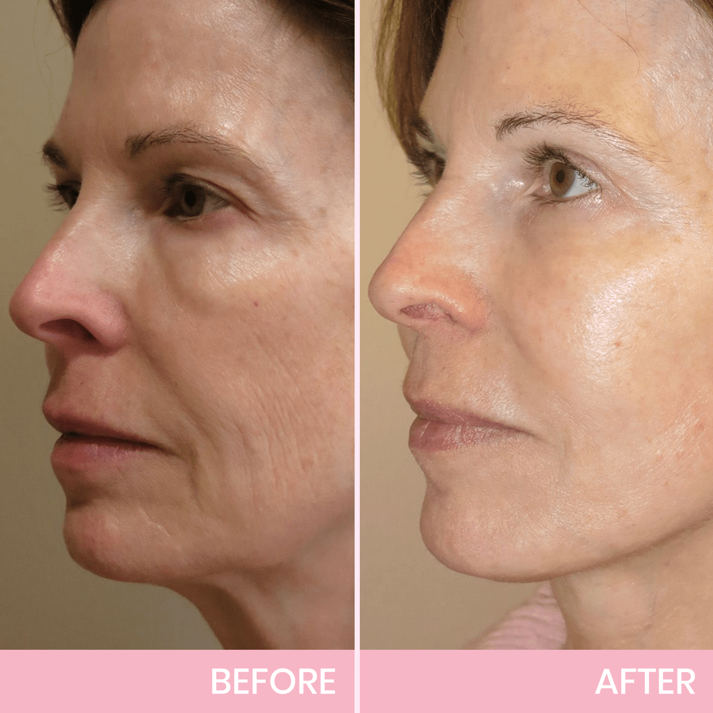 InvisiLift | Cinta Adhesiva Invisible para Lifting Facial