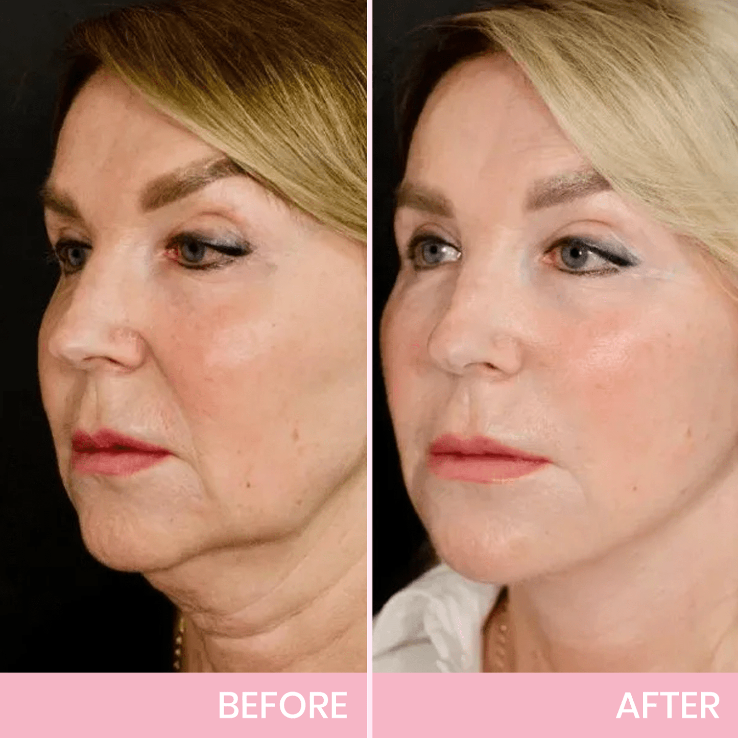 InvisiLift | Cinta Adhesiva Invisible para Lifting Facial