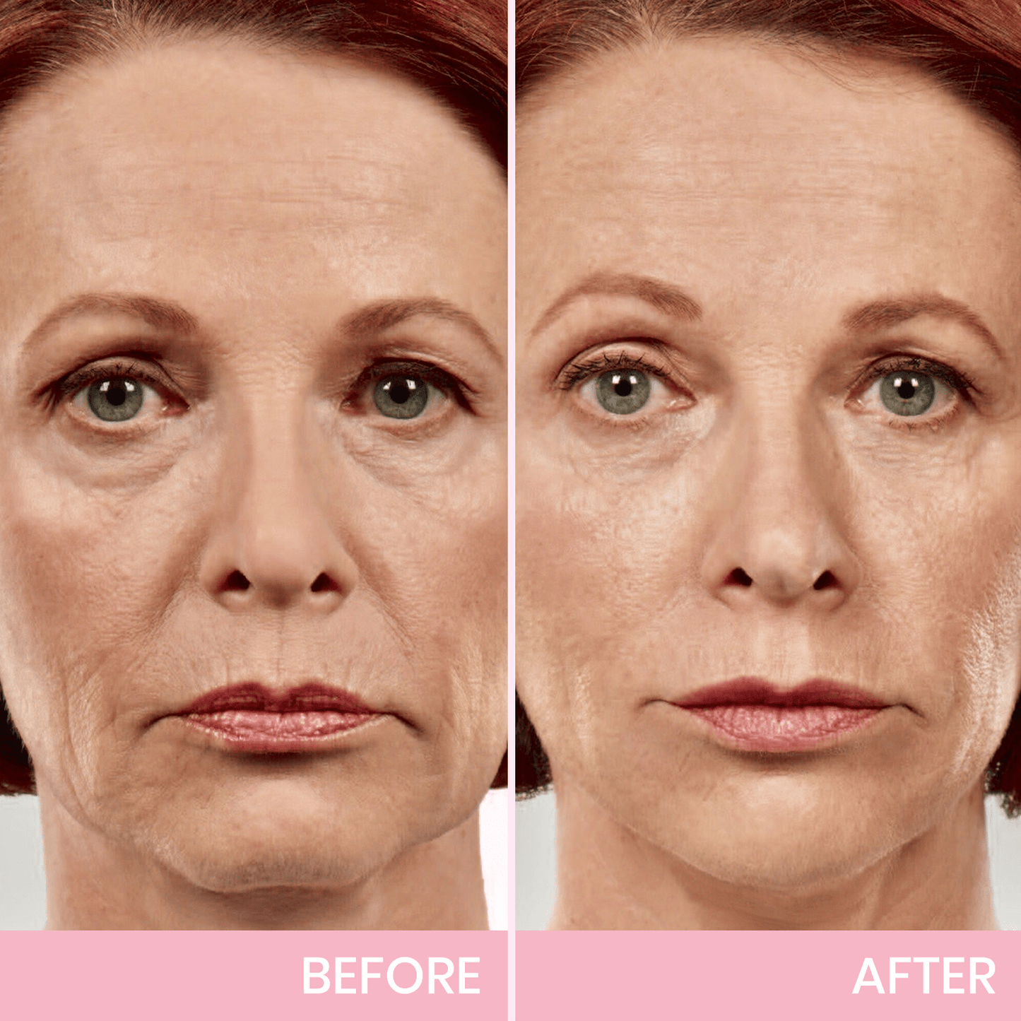 InvisiLift | Cinta Adhesiva Invisible para Lifting Facial