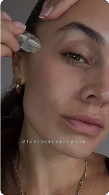 Kit de Sistema de Micro-Infusión Qure