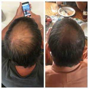 Purc | Aceite Natural para Prevenir la Caída del Cabello