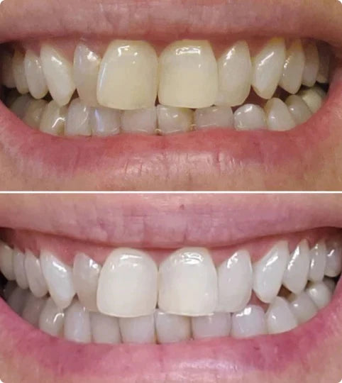 V34Colour™ |  Corrector Blanqueador Dental